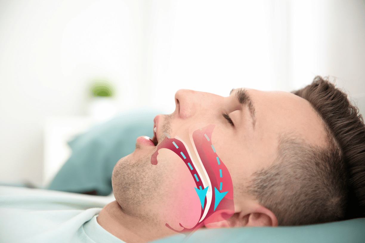 Understanding Sleep Apnea: How It Contributes to Loud Snoring